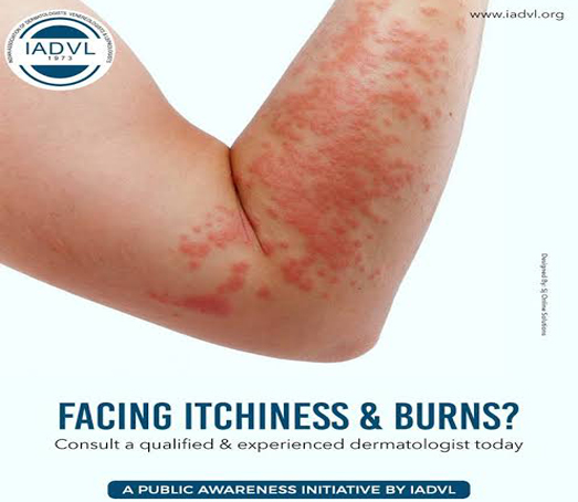 Itchness and Burn Treatment