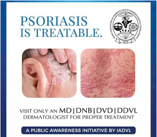 Psoriasis Treatment